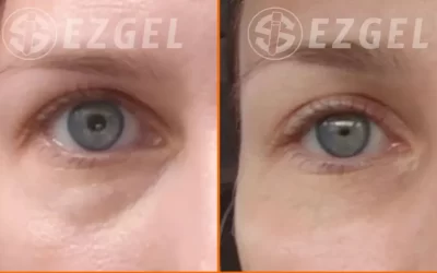 PRF Under Eye Injections: The Natural Alternative to Fillers