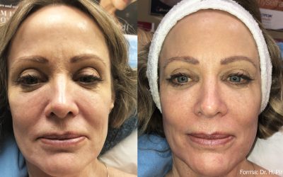 Morpheus8 Optimas Max: The Ultimate Face & Neck Rejuvenation Treatment