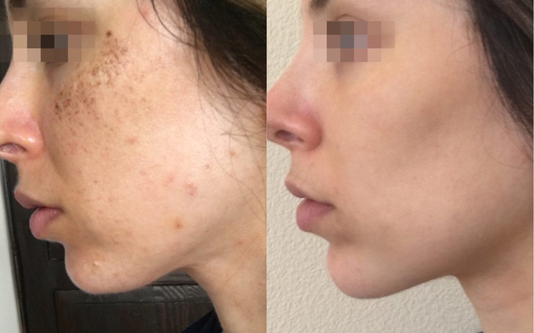 Lumecca IPL