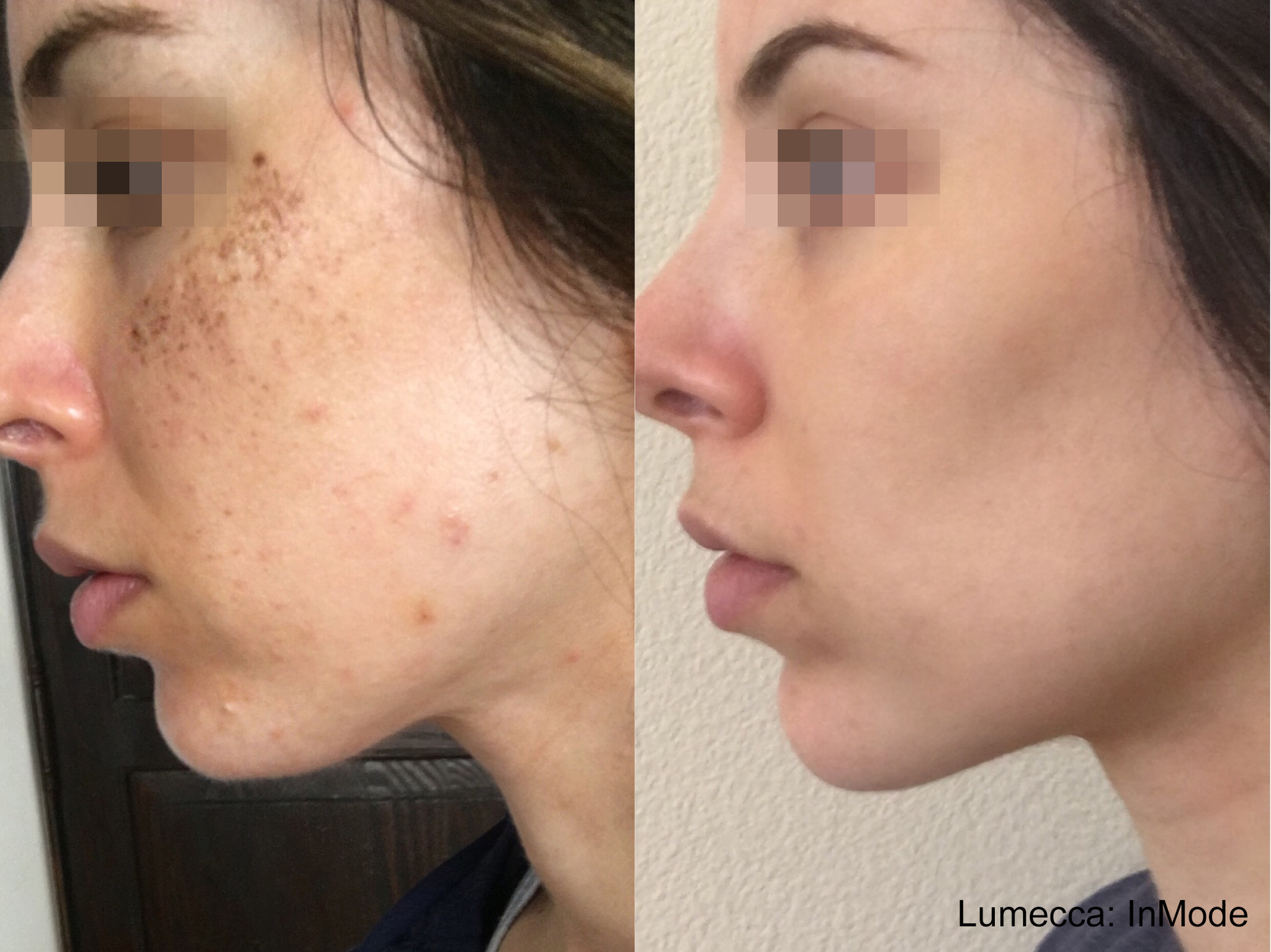 Lumecca IPL