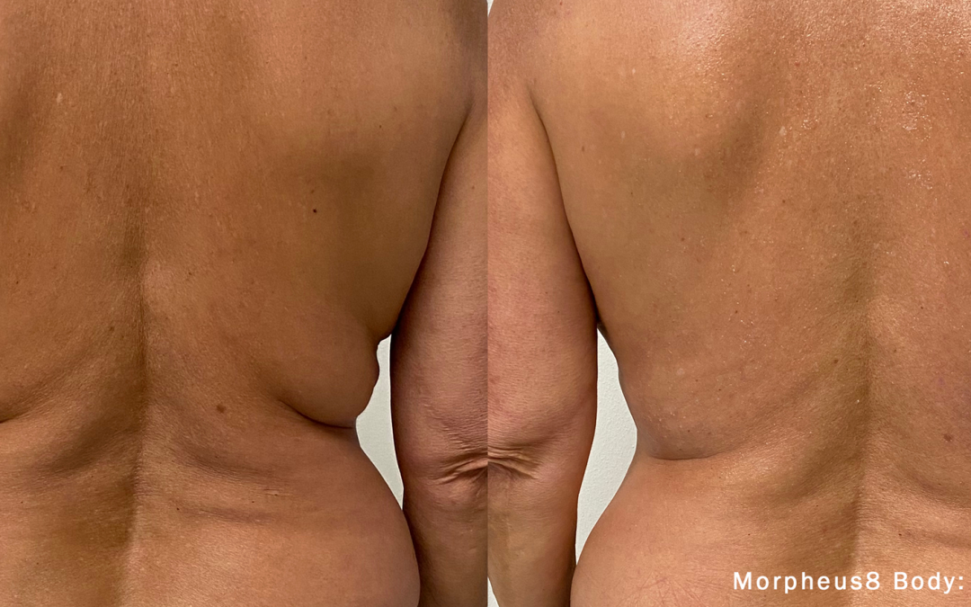 Morpheus8 Optimas Max: The Ultimate Stretch Mark Reduction and Skin Tightening Treatment
