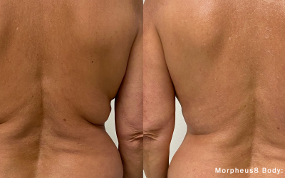 Morpheus8 Optimas Max: The Ultimate Stretch Mark Reduction and Skin Tightening Treatment