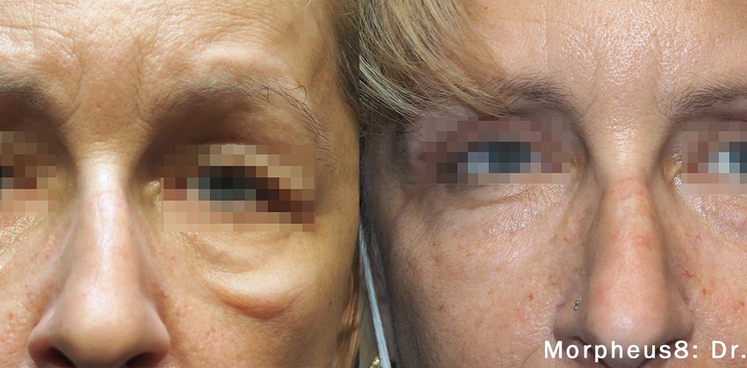 PRP Microneedling with SkinPen vs RF Microneedling with Morpheus8: Key Differences