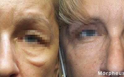 PRP Microneedling with SkinPen vs RF Microneedling with Morpheus8: Key Differences