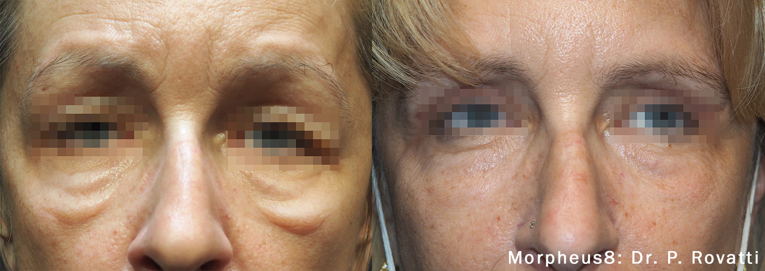 PRP Microneedling with SkinPen vs RF Microneedling with Morpheus8: Key Differences