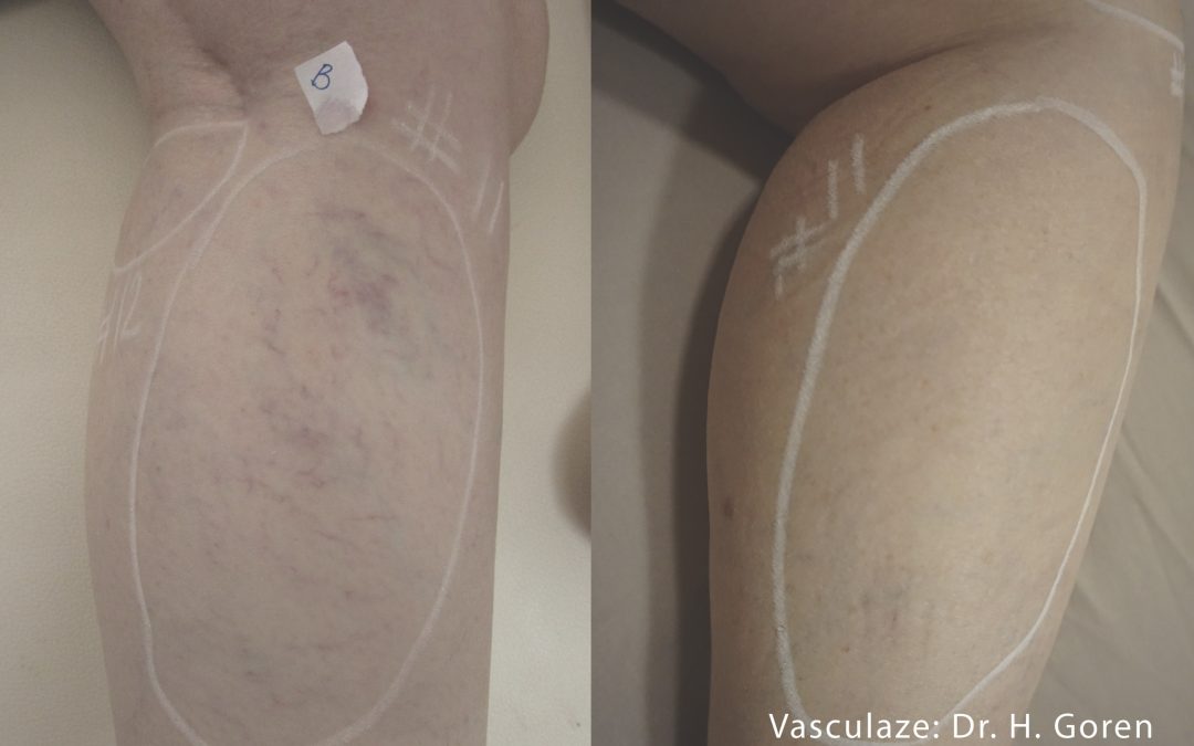 Vasculaze: The Ultimate Treatment for Spider Veins and Vascular Lesions