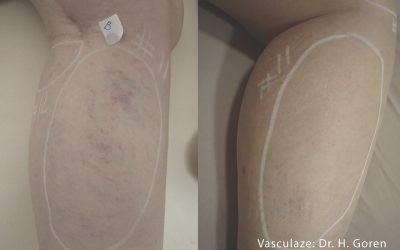 Vasculaze: The Ultimate Treatment for Spider Veins and Vascular Lesions