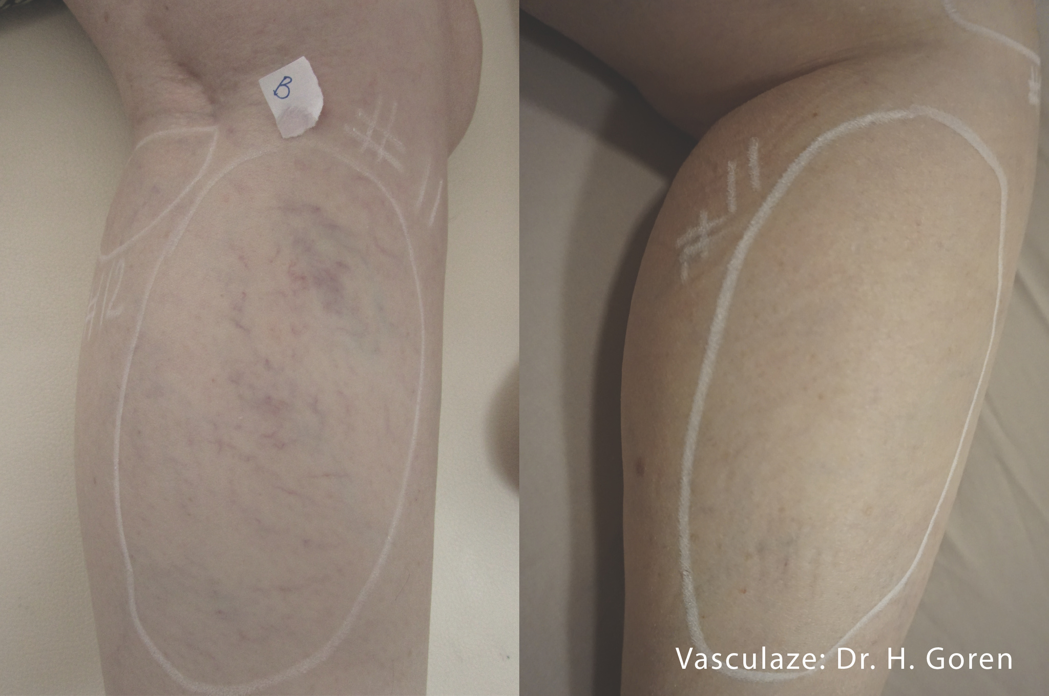 Vasculaze Laser
