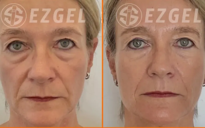 Top Under-Eye Treatments for Dark Circles & Puffiness