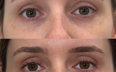 EZ-Gel vs. PRF: Which Is the Best Treatment for Under-Eye Rejuvenation?