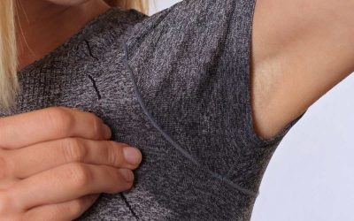 Morpheus8 Optimas Max: The Ultimate Hyperhidrosis Treatment